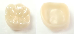 オールジルコニア