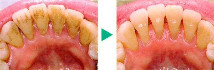 歯のクリーニング
