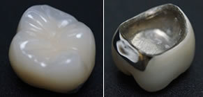 硬質レジン前装冠