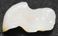 ハイブリッドインレー