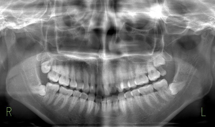 レントゲン写真