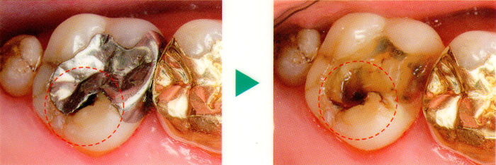 2次むし歯の進行