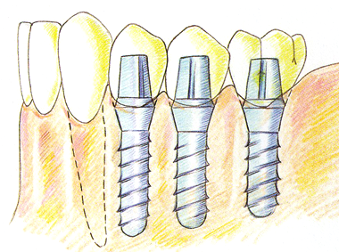 インプラント治療