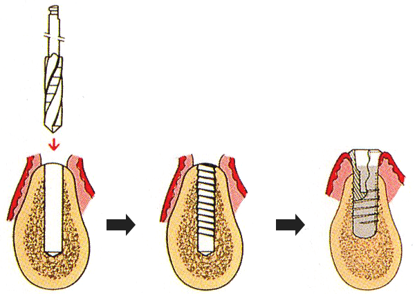 インプラント1次手術