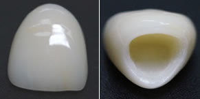 ジルコニアセラミック