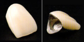 メタルハイブリッドレジン