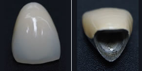 メタルセラミック