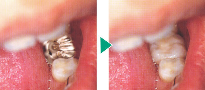 オールセラミック