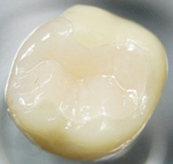 セラミック詰め物